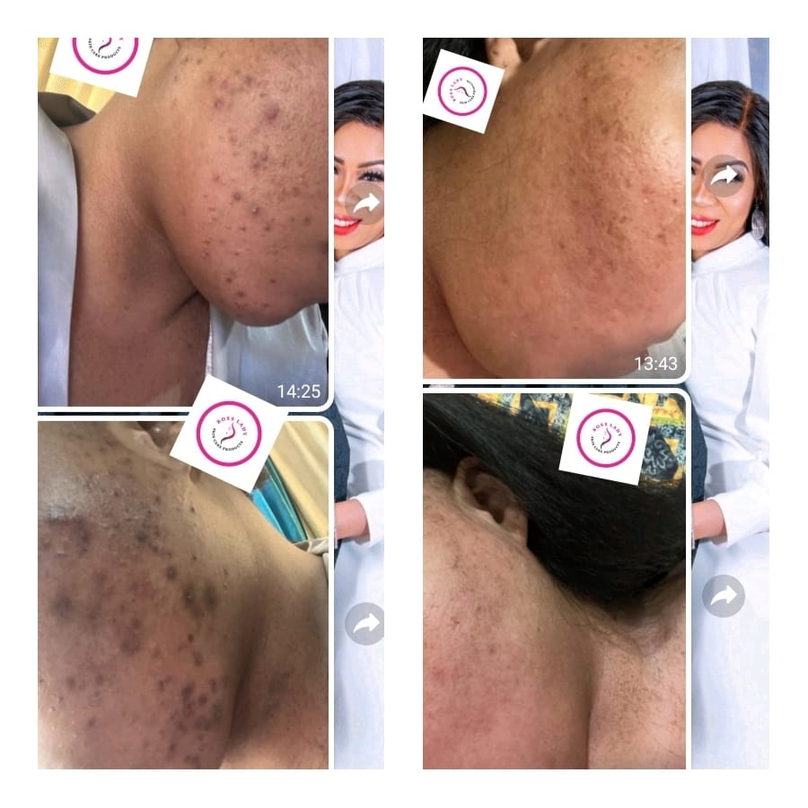 Body Acne & Scarring — customer result