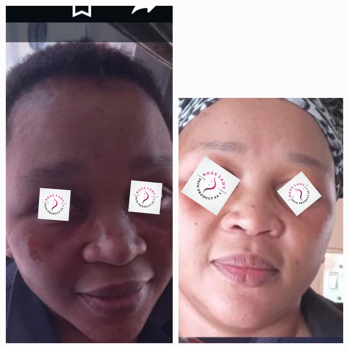 Blemish & Breakout Repair — customer result