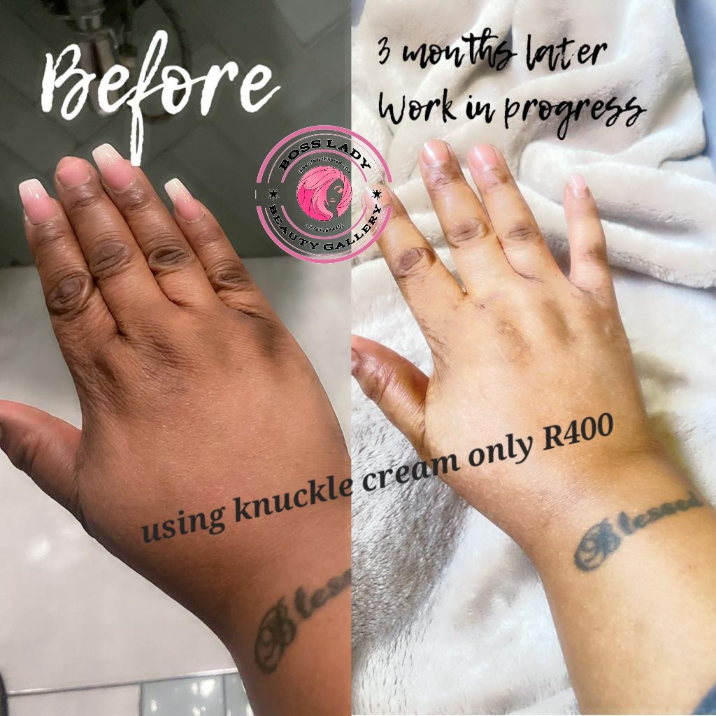 Knuckle Lightening Cream — customer result