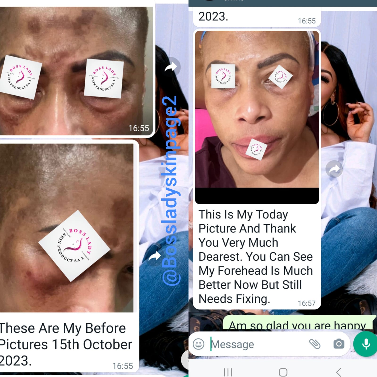 Melasma & Forehead Pigmentation — customer result