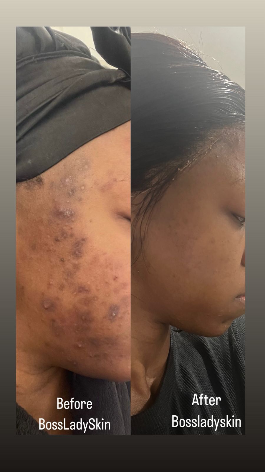 Back & Shoulder Acne Treatment — customer result